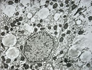 F,1y. | glycogenosis type II. (glycogen dissolved due to UA blockstaining) F,1y. | glycogenosis type II. (glycogen dissolved due to UA blockstaining)